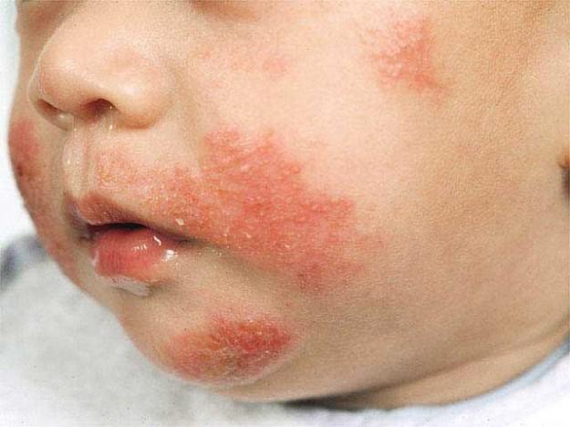 Dermatite 11 anni - Cancer de gura simptome