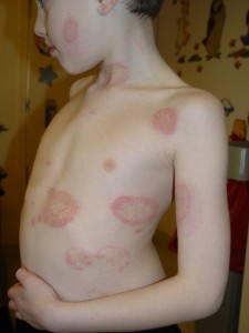 ringworm