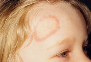 Immagine 20 tinea faciei