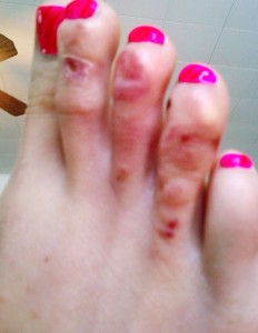 Immagine 25 tinea pedis