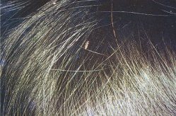 Immagine 31 pediculosi