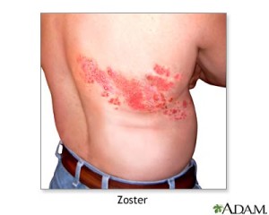 Immagine 7 Herpes Zoster