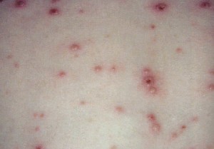 Immagine 8 Varicella Zoster
