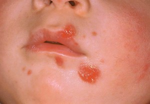 Immagine 10 impetigine non bollosa